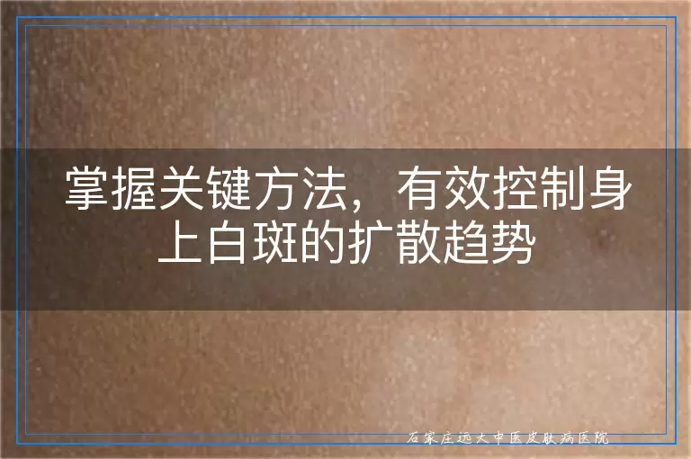 掌握关键方法，有效控制身上白斑的扩散趋势