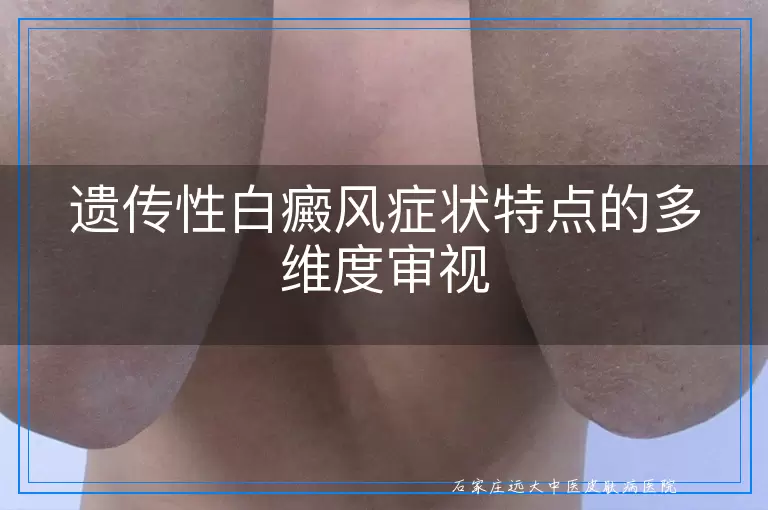 遗传性白癜风症状特点的多维度审视