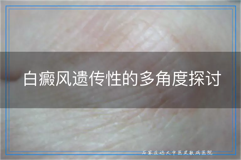 白癜风遗传性的多角度探讨