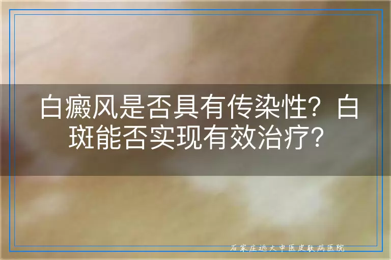 白癜风是否具有传染性？白斑能否实现有效治疗？