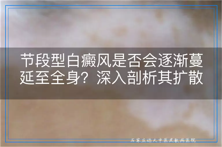 节段型白癜风是否会逐渐蔓延至全身？深入剖析其扩散特性与影响因素