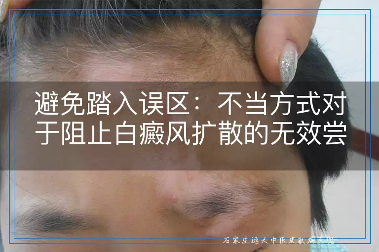 避免踏入误区：不当方式对于阻止白癜风扩散的无效尝试