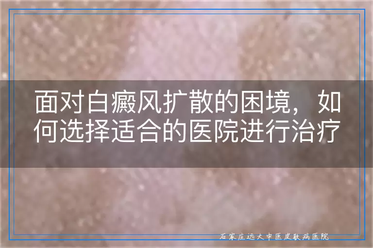 面对白癜风扩散的困境，如何选择适合的医院进行治疗