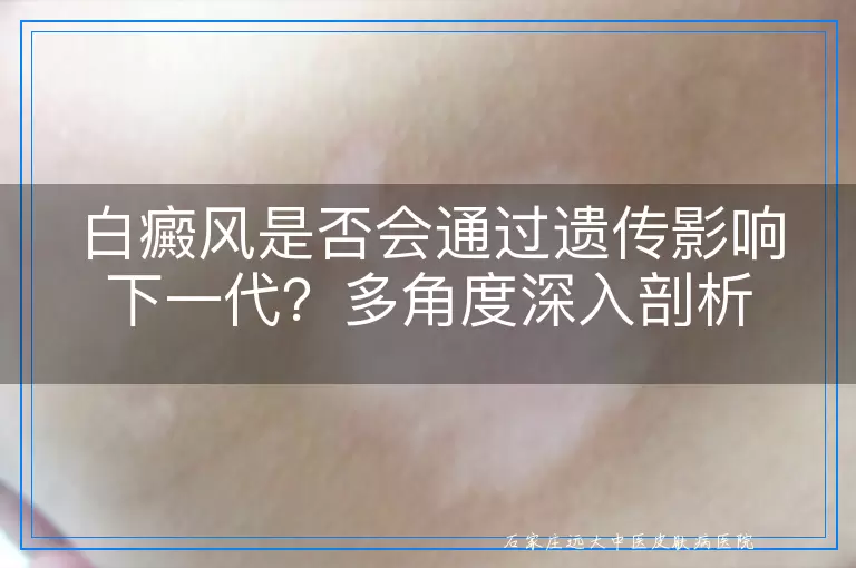 白癜风是否会通过遗传影响下一代？多角度深入剖析