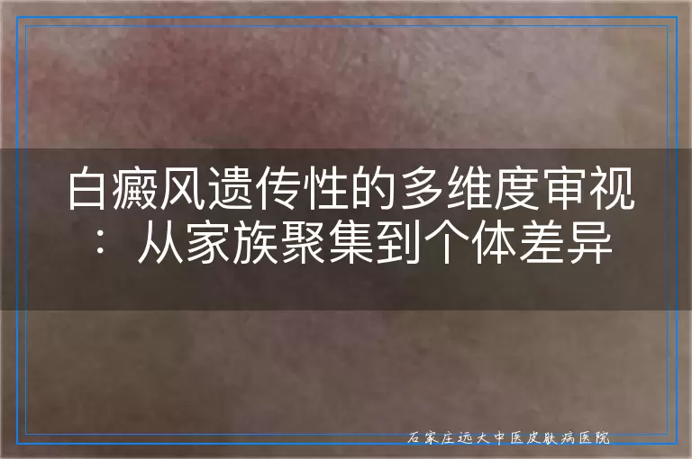白癜风遗传性的多维度审视：从家族聚集到个体差异