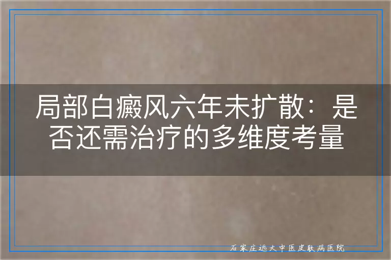 局部白癜风六年未扩散：是否还需治疗的多维度考量
