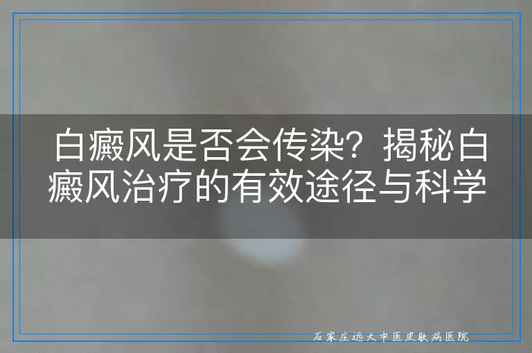 白癜风是否会传染？揭秘白癜风治疗的有效途径与科学方法