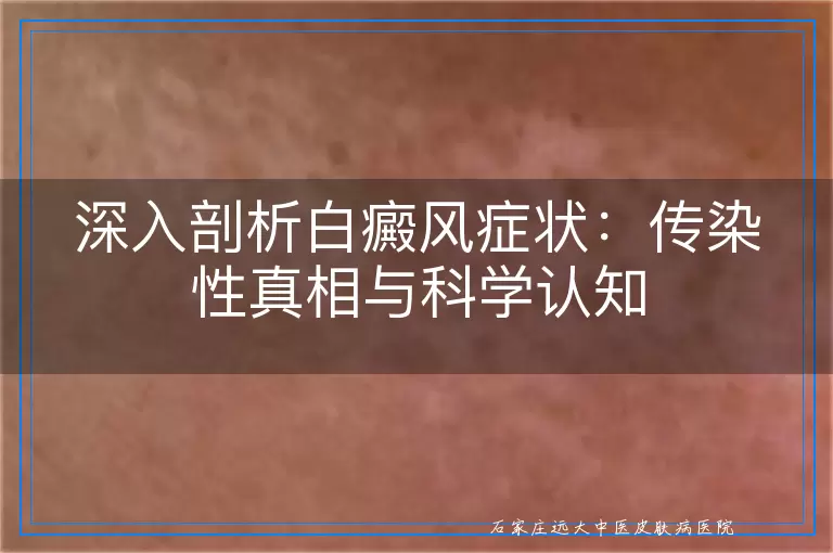深入剖析白癜风症状：传染性真相与科学认知