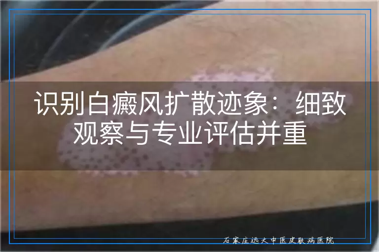 识别白癜风扩散迹象：细致观察与专业评估并重