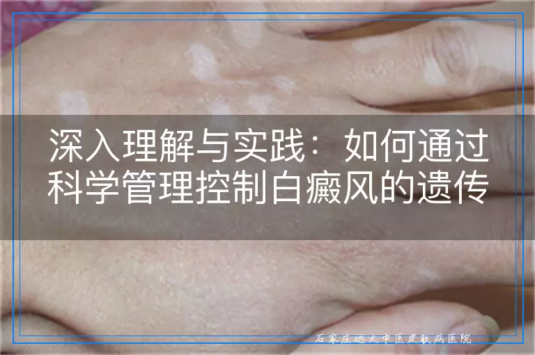 深入理解与实践：如何通过科学管理控制白癜风的遗传因素