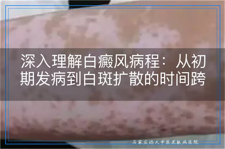 深入理解白癜风病程：从初期发病到白斑扩散的时间跨度与影响因素