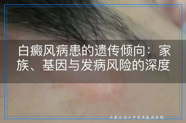 白癜风病患的遗传倾向：家族、基因与发病风险的深度视角