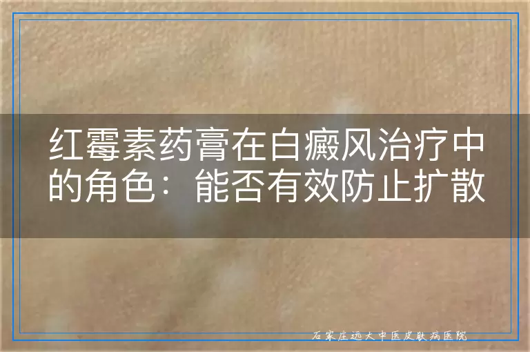 红霉素药膏在白癜风治疗中的角色：能否有效防止扩散？