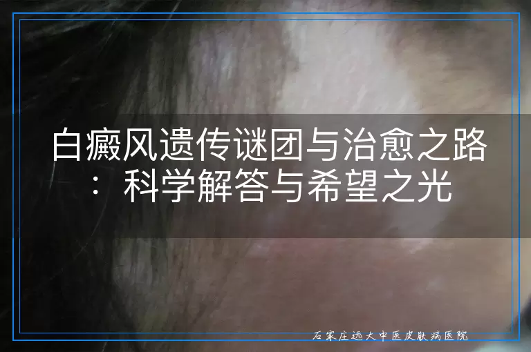 白癜风遗传谜团与治愈之路：科学解答与希望之光