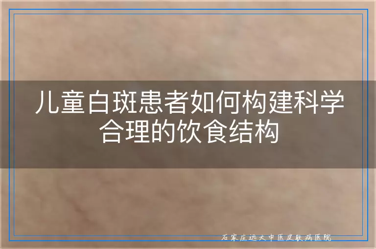 儿童白斑患者如何构建科学合理的饮食结构