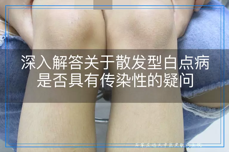 深入解答关于散发型白点病是否具有传染性的疑问