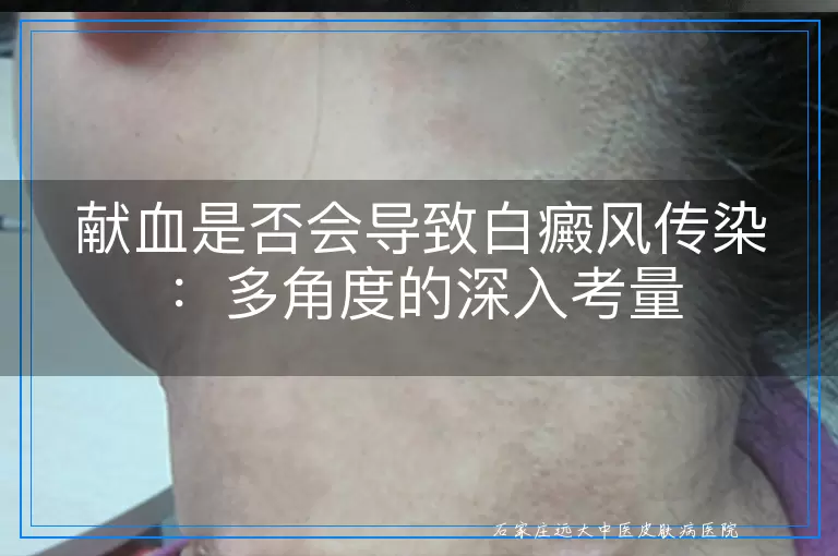 献血是否会导致白癜风传染：多角度的深入考量