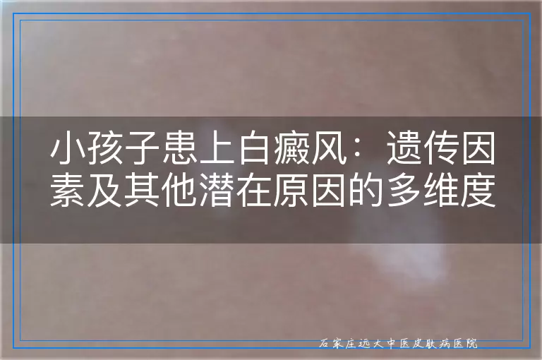 小孩子患上白癜风：遗传因素及其他潜在原因的多维度探讨