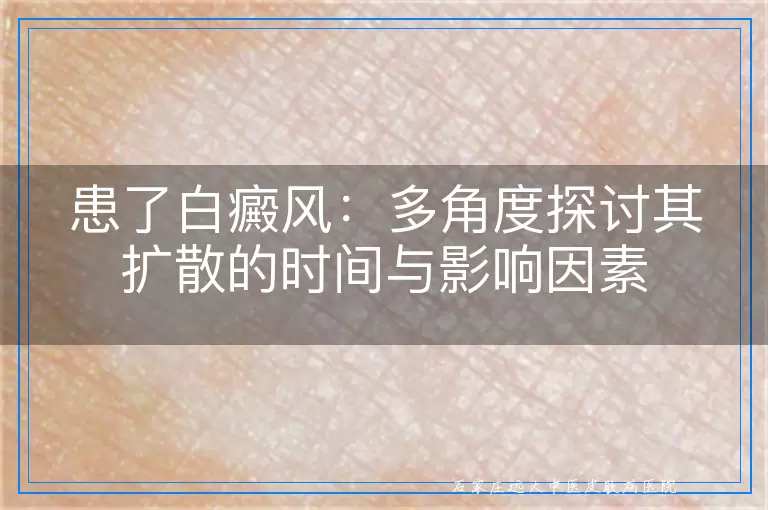 患了白癜风：多角度探讨其扩散的时间与影响因素