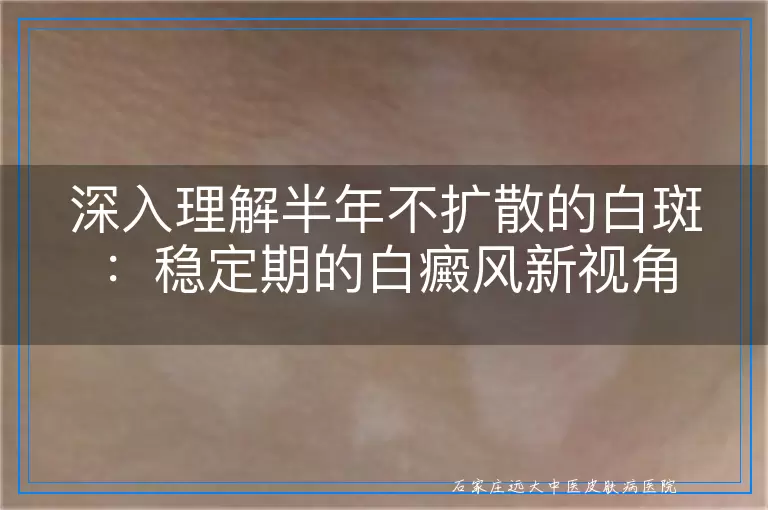 深入理解半年不扩散的白斑：稳定期的白癜风新视角