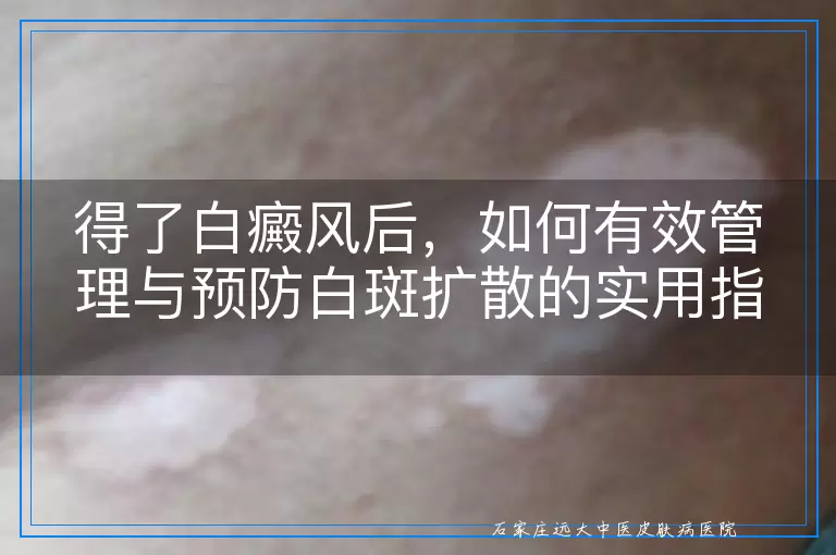 得了白癜风后，如何有效管理与预防白斑扩散的实用指南