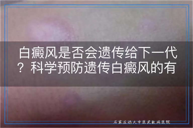 白癜风是否会遗传给下一代？科学预防遗传白癜风的有效方法