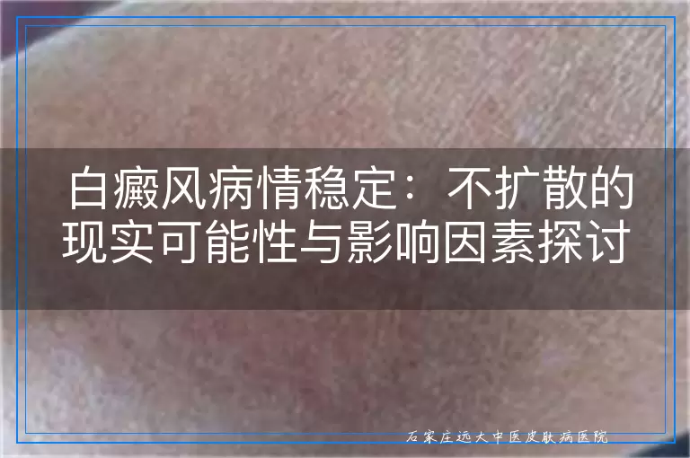 白癜风病情稳定：不扩散的现实可能性与影响因素探讨