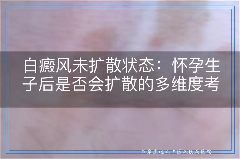 白癜风未扩散状态：怀孕生子后是否会扩散的多维度考量