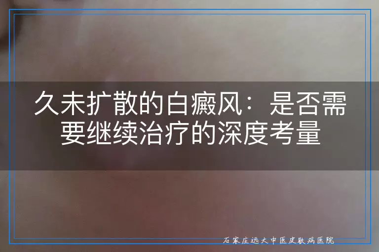 久未扩散的白癜风：是否需要继续治疗的深度考量