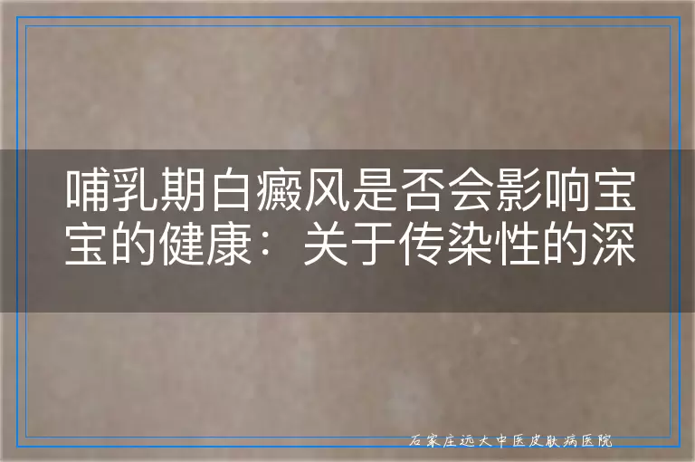 哺乳期白癜风是否会影响宝宝的健康：关于传染性的深度释疑