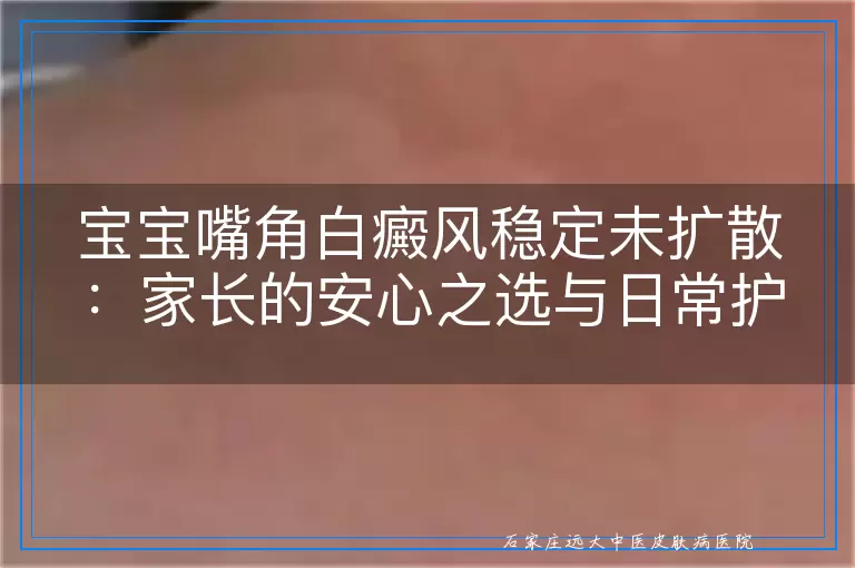 宝宝嘴角白癜风稳定未扩散：家长的安心之选与日常护理指南