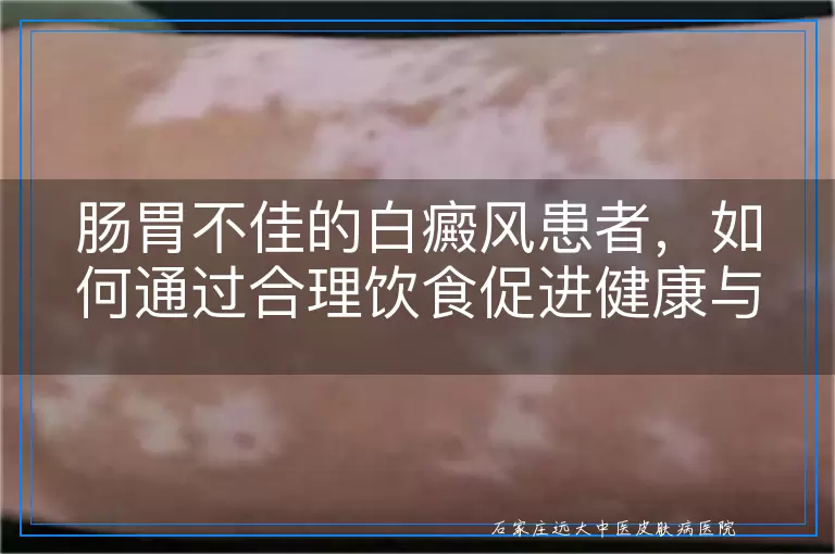 肠胃不佳的白癜风患者，如何通过合理饮食促进健康与病情管理？