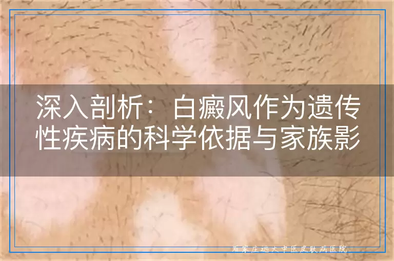 深入剖析：白癜风作为遗传性疾病的科学依据与家族影响