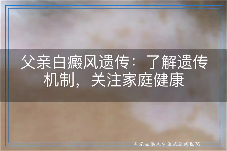 父亲白癜风遗传：了解遗传机制，关注家庭健康