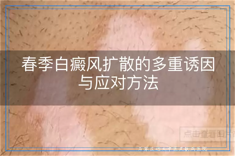 春季白癜风扩散的多重诱因与应对方法