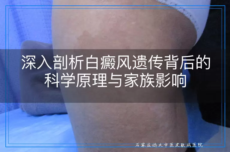 深入剖析白癜风遗传背后的科学原理与家族影响
