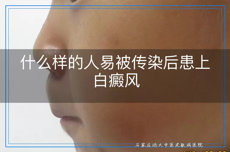 什么样的人易被传染后患上白癜风