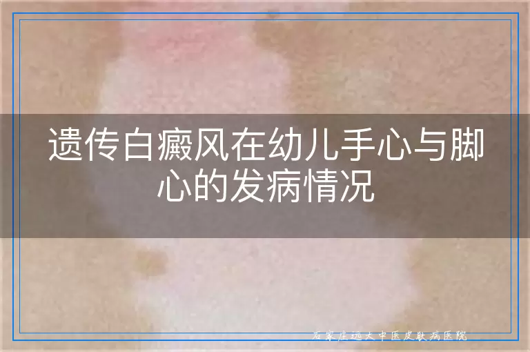 遗传白癜风在幼儿手心与脚心的发病情况