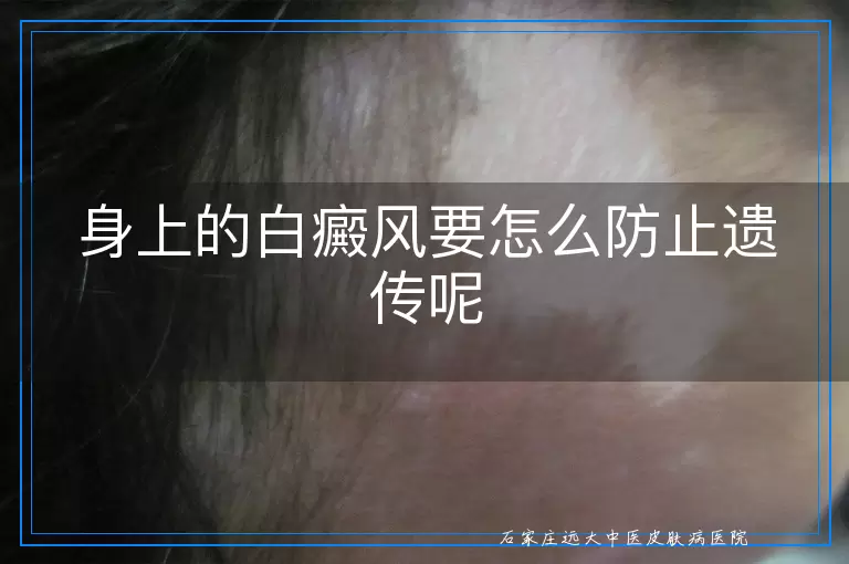 身上的白癜风要怎么防止遗传呢