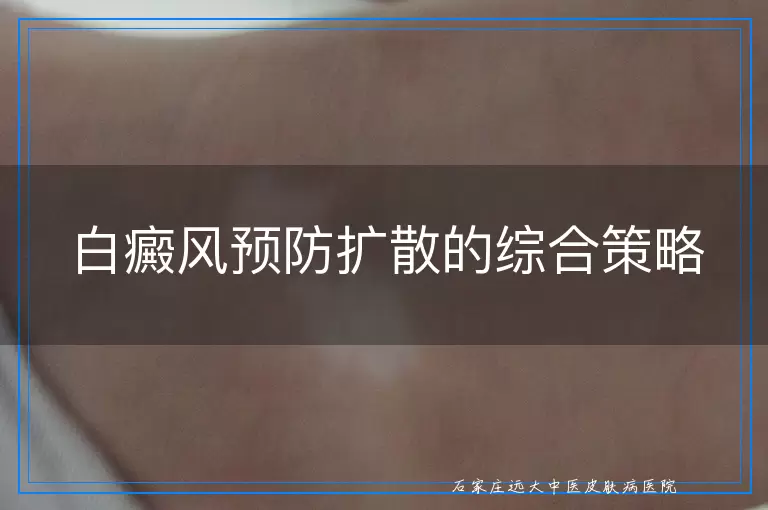 白癜风预防扩散的综合策略