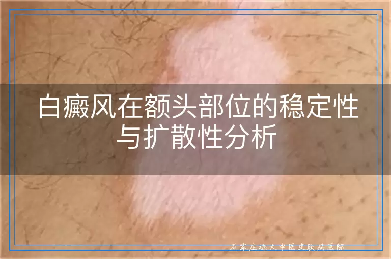 白癜风在额头部位的稳定性与扩散性分析