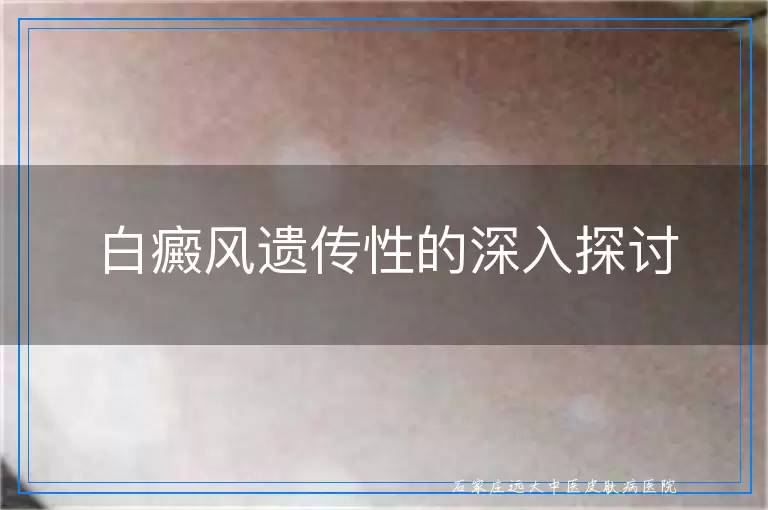 白癜风遗传性的深入探讨