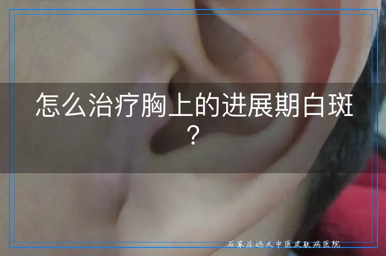 怎么治疗胸上的进展期白斑？