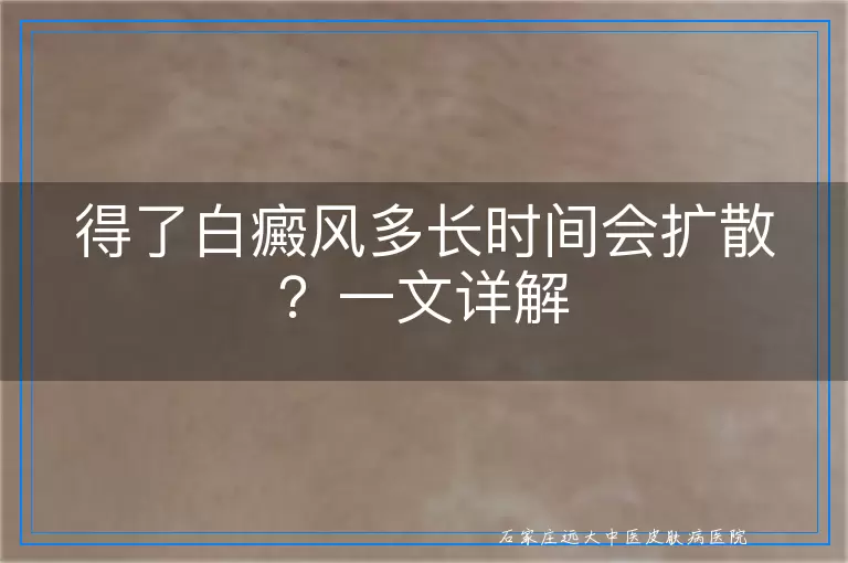 得了白癜风多长时间会扩散？一文详解