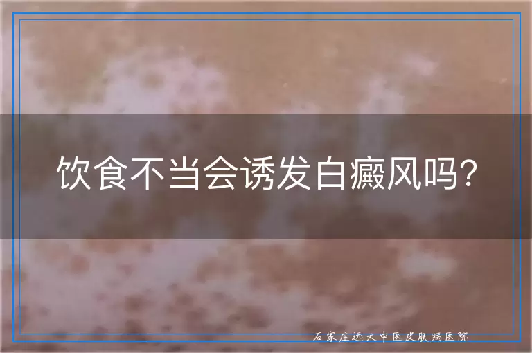 饮食不当会诱发白癜风吗？