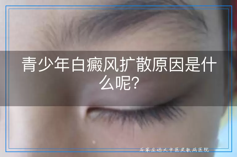 青少年白癜风扩散原因是什么呢？