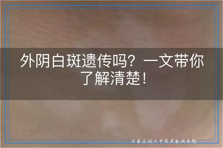 外阴白斑遗传吗？一文带你了解清楚！
