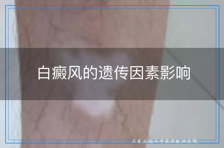 白癜风的遗传因素影响