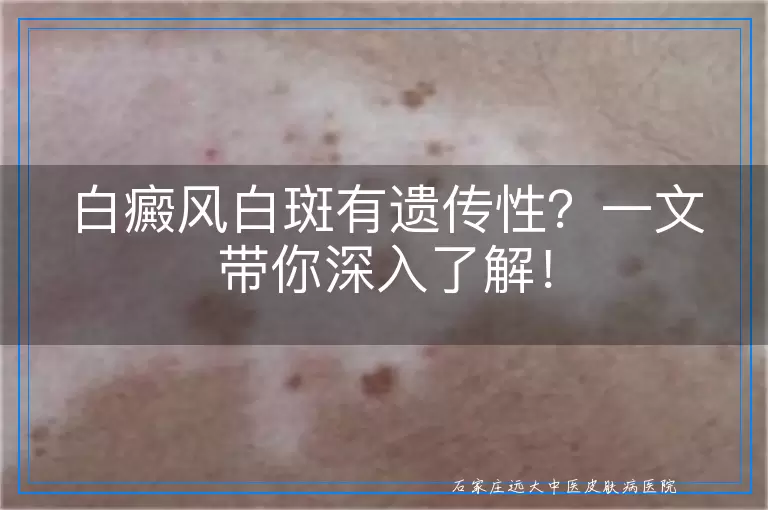 白癜风白斑有遗传性？一文带你深入了解！