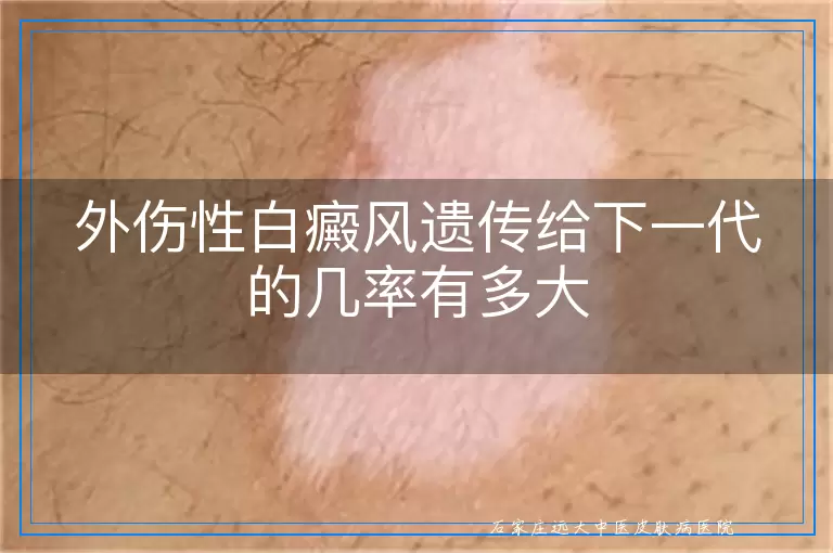 外伤性白癜风遗传给下一代的几率有多大